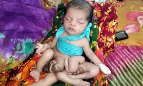 মারা গেছে ৭ হাত-পা নিয়ে জন্ম নেয়া আলোচিত সেই নবজাতক