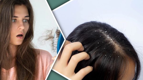 চুলের খুশকি ও রুক্ষতা দূর করার ৫ উপায়
